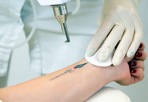 Лазерное удаление татуировки – к чему готовиться